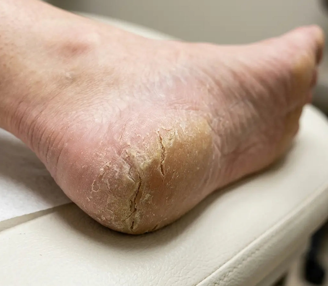 Shieftfield balm- Anti cracking feet moisturizer